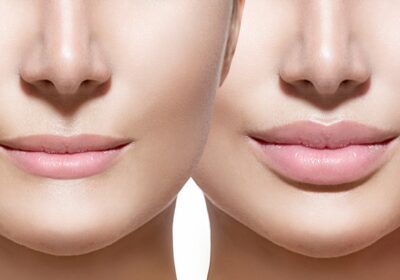 Understanding The Lips Reduction Need And Surgery