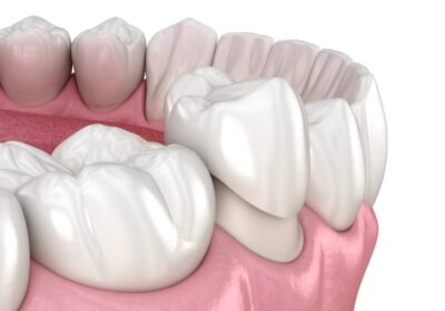 How Has Technological Development Enhanced the Crowns’ General Durability and Quality?