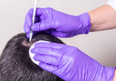 How To Overcome Male Pattern Baldness By Hair Transplantation?