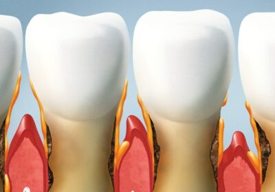 Dental Bridges vs. Implants: Finding What’s Best for You