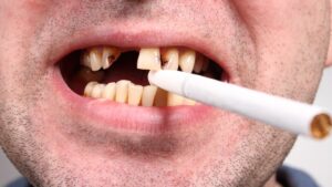 The Impact of Smoking on Oral Health