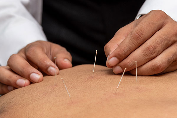 acupuncture treatment