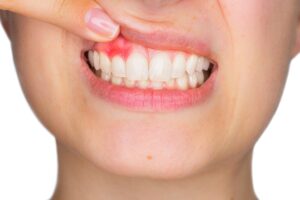 How to Prevent Cavities and Tooth Decay: Essential Tips for Healthy Teeth