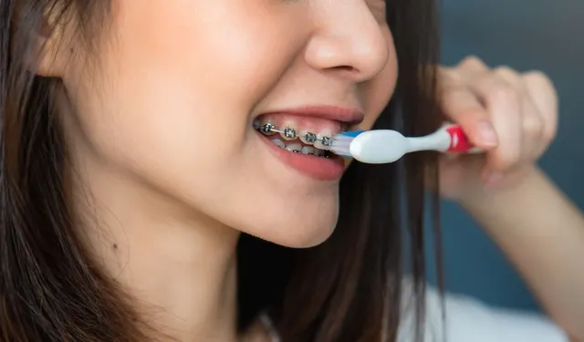 Maintain Oral Health with Braces