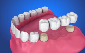 Understanding Dental Crowns and Bridges: A Comprehensive Guide