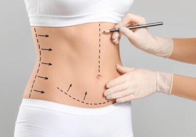 Who Is a Good Candidate for a Tummy Tuck