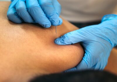 Clinical Applications of Dry Needling: Evidence-Based Outcomes in Singapore