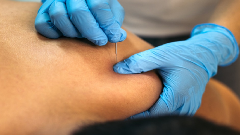 Dry Needling